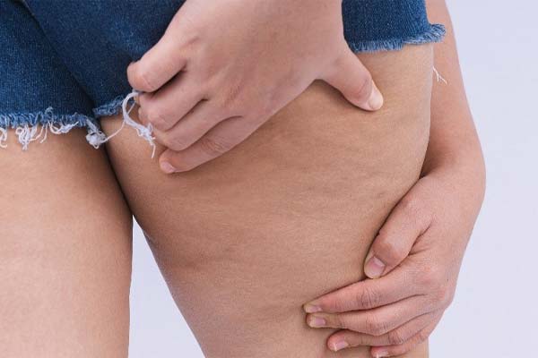 Bloccato dalla cellulite? Basta guardare questi suggerimenti!